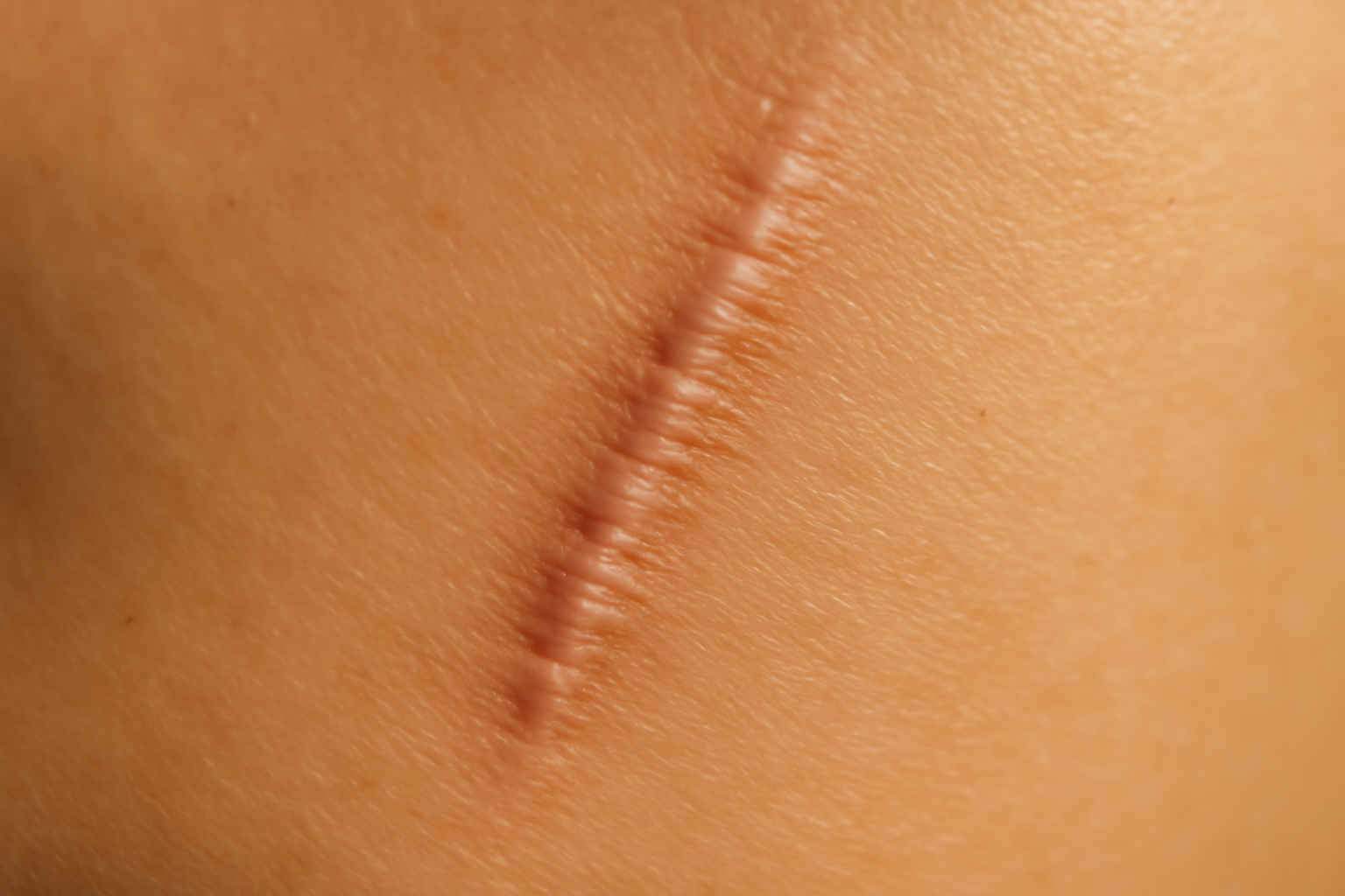 Cicatrice d'abdominoplastie