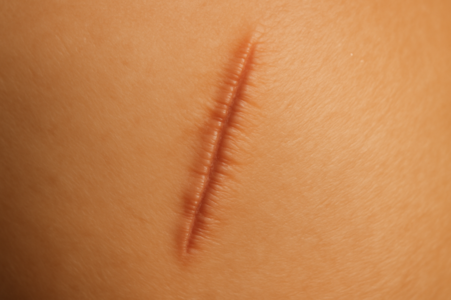 Cicatrice de blépharoplastie