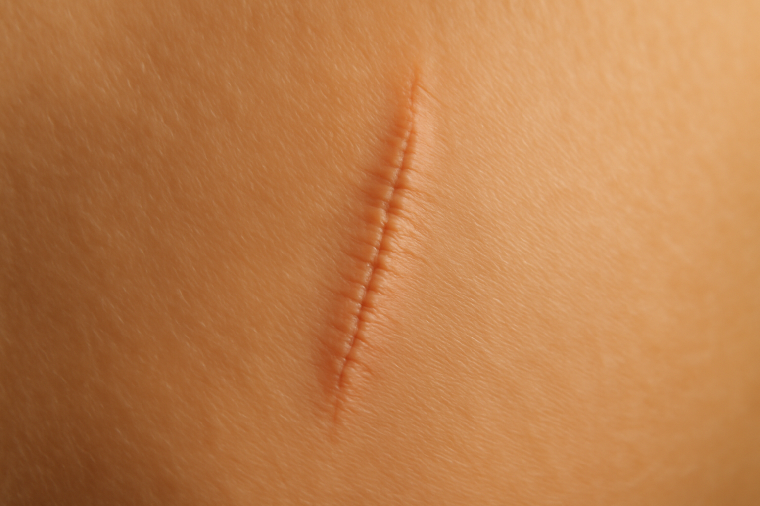Cicatrice de bodylift