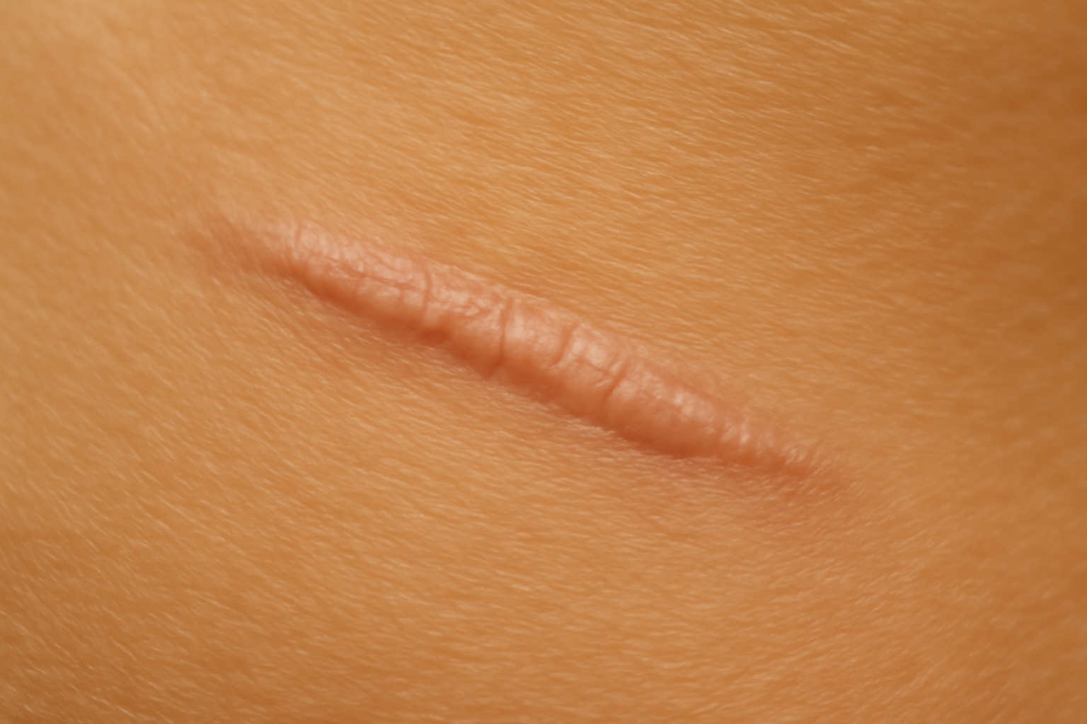 Cicatrice de brachioplastie