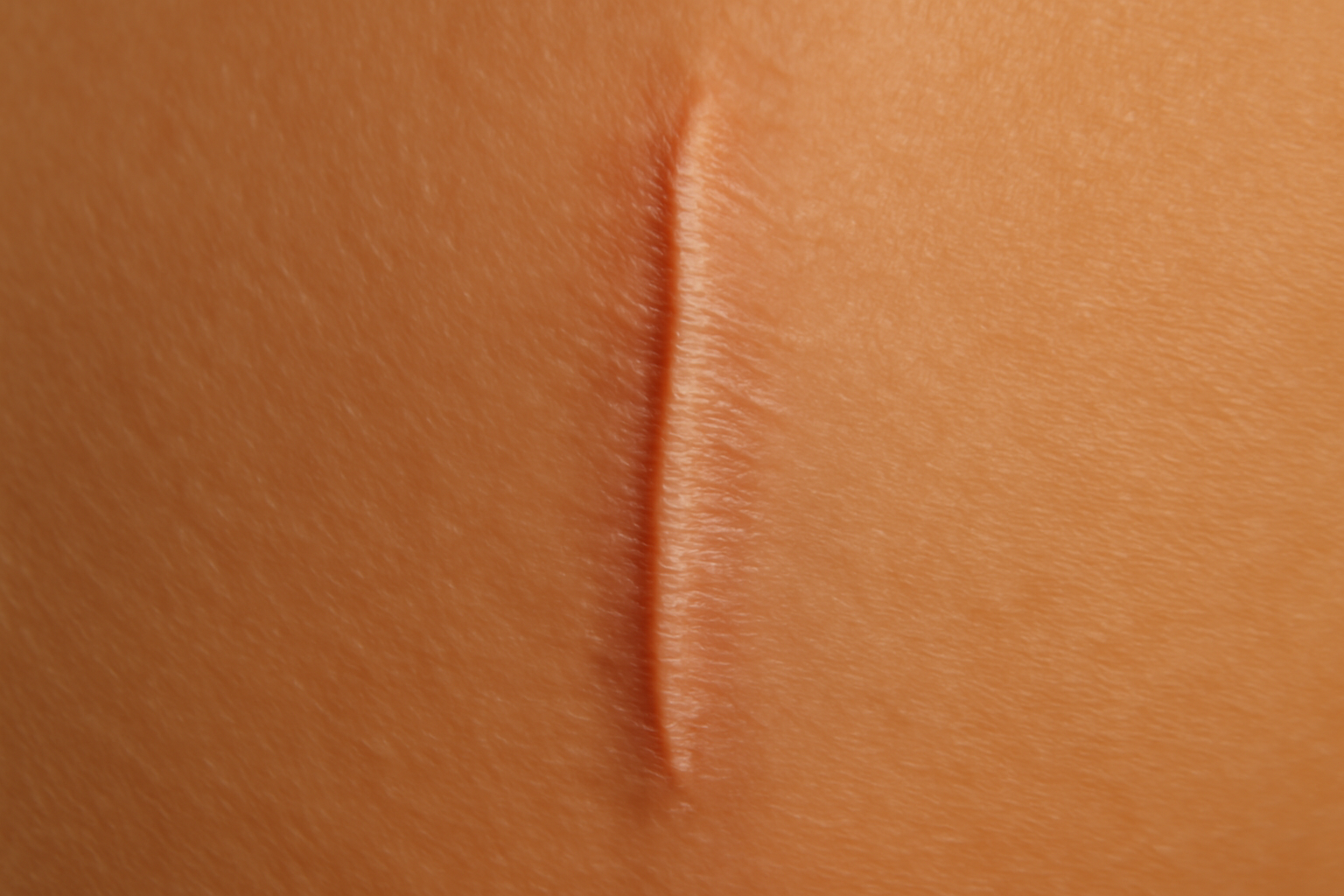 Cicatrice de lifting cervico-facial