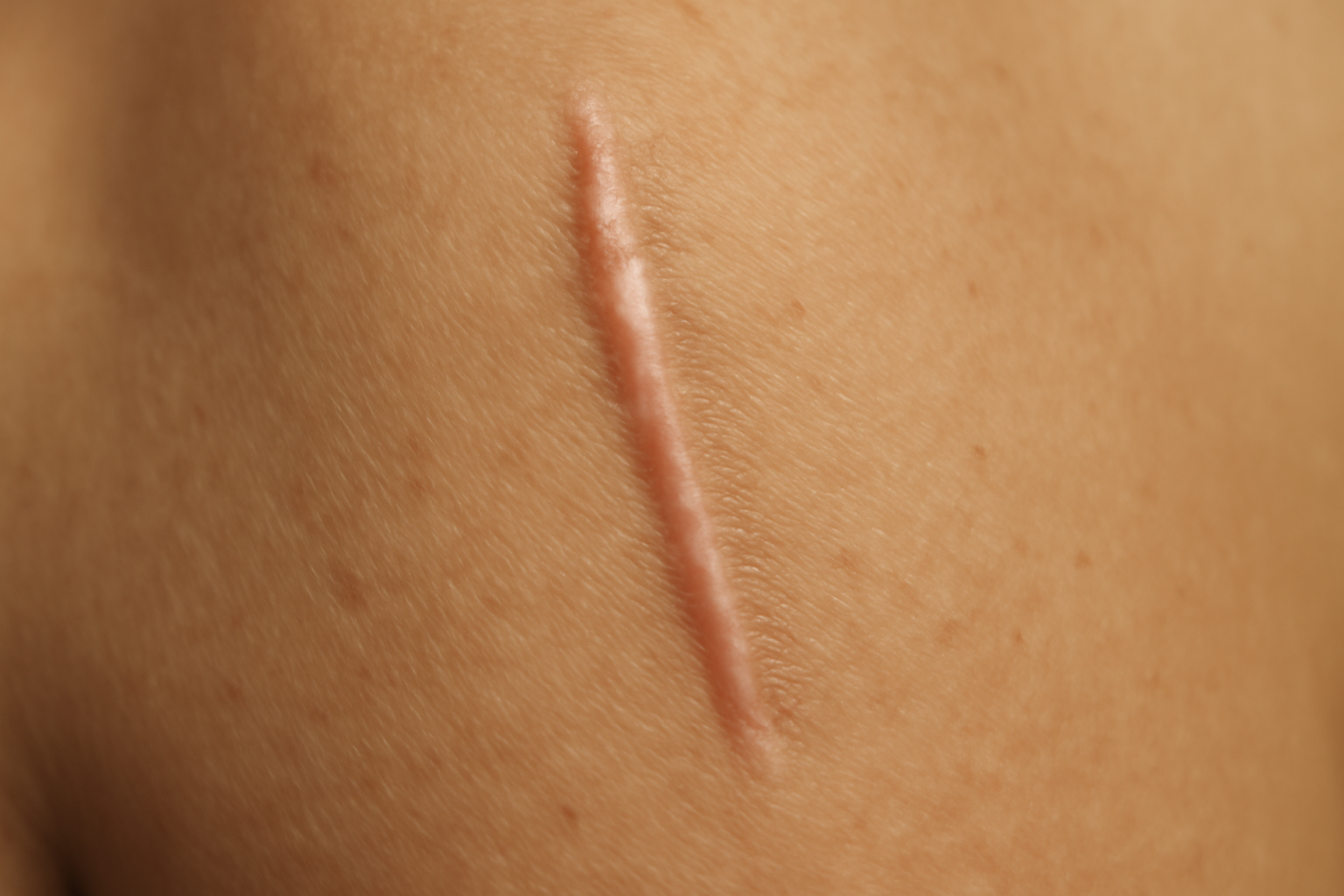 Cicatrice de lifting des seins (mastopexie)