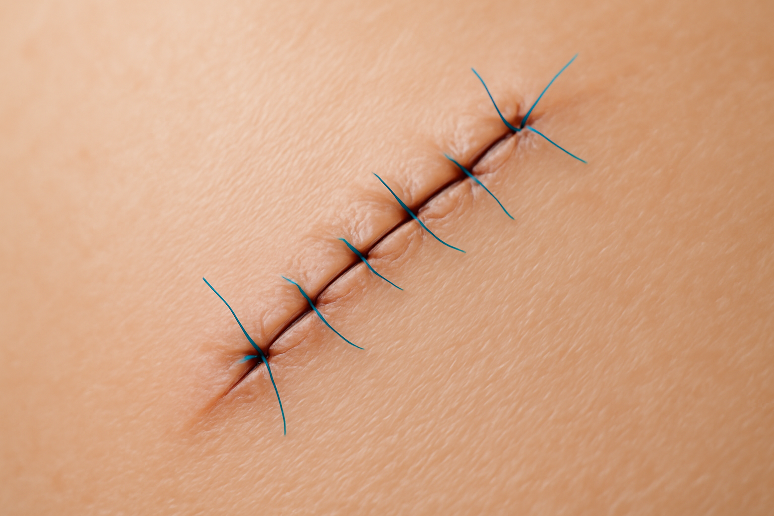 Cicatrice de liposuccion