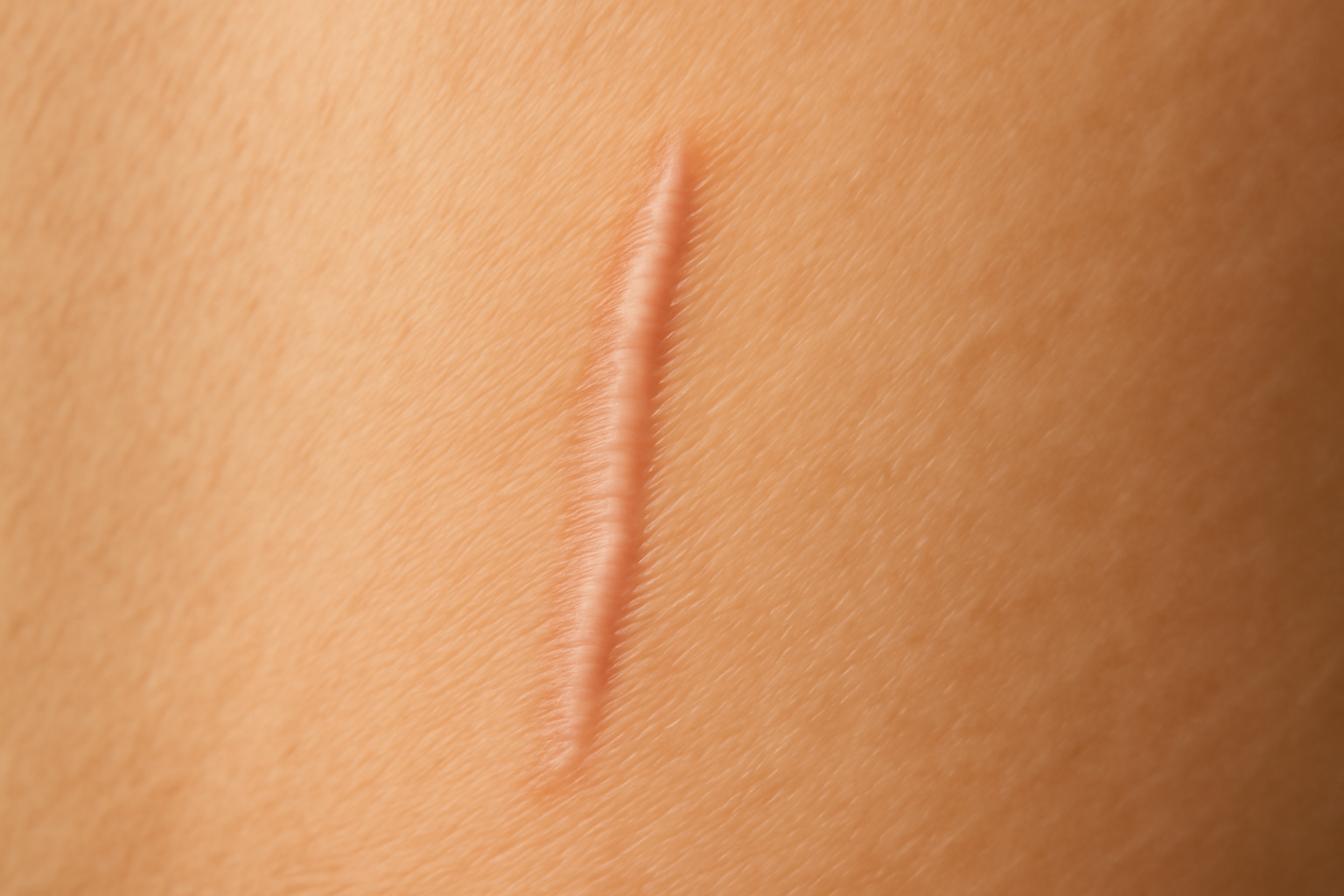 Cicatrice rouge et gonflée